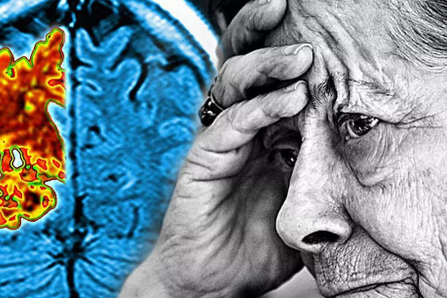 آلزایمر (Alzheimer’s Disease)، شایعترین نوع زوال عقل است؛ یک بیماری پیشرونده که بهمرور، شدیدتر میشود.