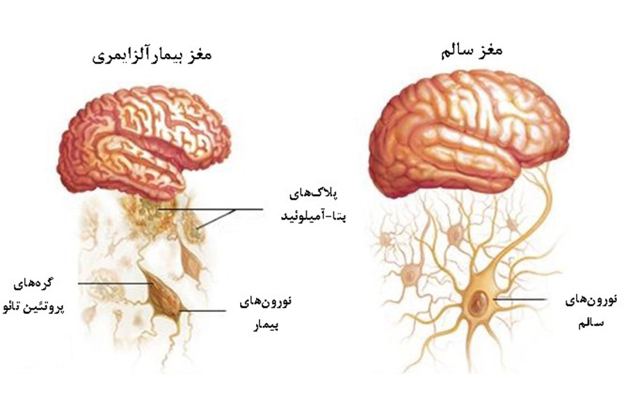 در آلزایمر، نورونهای سالم از کار میافتند، ارتباط خود را با سایر نورونها از دست میدهند و میمیرند.