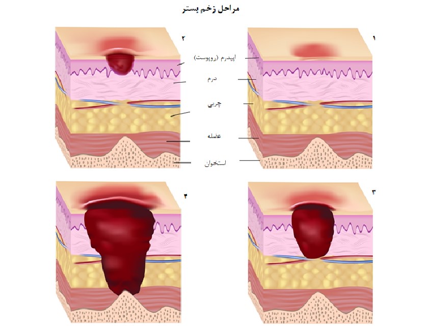 زخم بستر، براساس عمق و شدت آسیب بافتی به 4 درجه، تقسیمبندی میشود که هریک، علائم مختص خود را دارند.