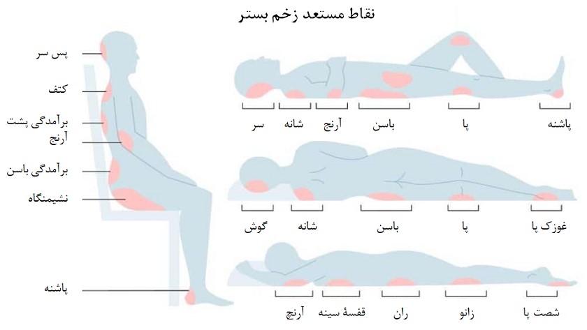 زخم بستر، بسته به نحوۀ قرارگیری سالمند، در قسمتهای مختلف بدن، اتفاق میافتد.