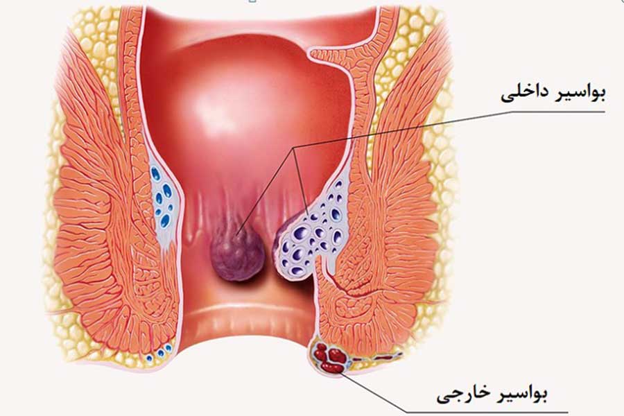 انواع بواسیر در سالمندان