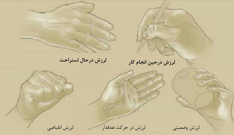 انواع لرزش در سالمندان