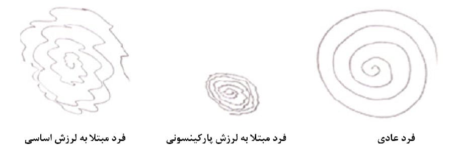 روشهای تشخیص لرزش سالمندان