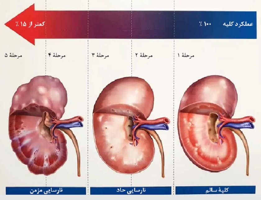 نارسایی کلیوی، 5 مرحله دارد که با آزمایش خون و بررسی میزان فیلتراسیون گلومرولی (GFR) مشخص میشوند.