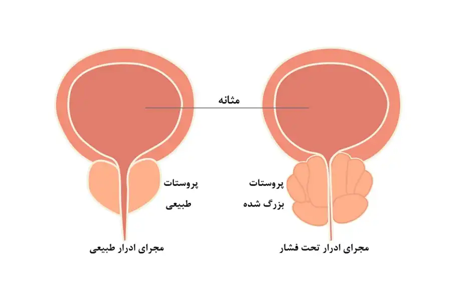 احتباس ادرار مزمن در مردان سالمند مبتلابه بزرگی خوشخیم پروستات، بیشاز هر گروه دیگری دیده میشود.
