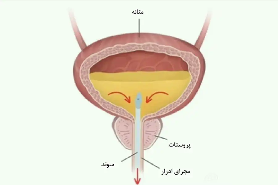 استفاده از سوند باعث تخلیه ادرار از مثانه شده و لازم است تا زمان تکمیل درمان ادرار نکردن سالمندان (بهویژه در موارد ناشیاز مشکلات عصبی) بیمار از سوند استفاده کند.