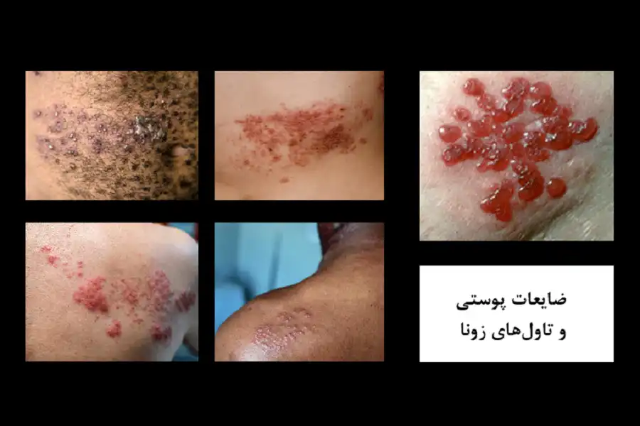 در اکثر افراد، انواع ضایعات پوستی و تاولهای زونا، درعرض 2 تا 4 هفته کاملاً ازبین میروند.