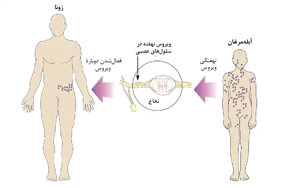ویروس واریسلا زوستر، پساز فعالشدنِ دوباره، تکثیر میشود و درطول اعصاب، به سمت پوست بازمیگردد و به این ترتیب، درد و ضایعات پوستی، در انتهای مسیرهای عصبی ایجاد میشوند.