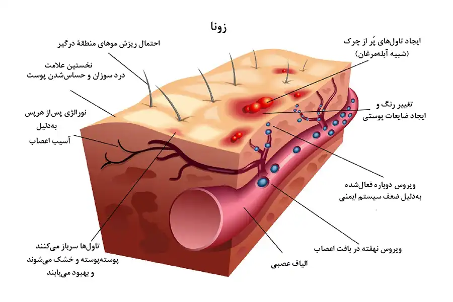 نزدیکبه 4 درصد سالمندان بهدلیل شدت عوارض زونا، مستلزم بستریشدن در بیمارستان هستند.