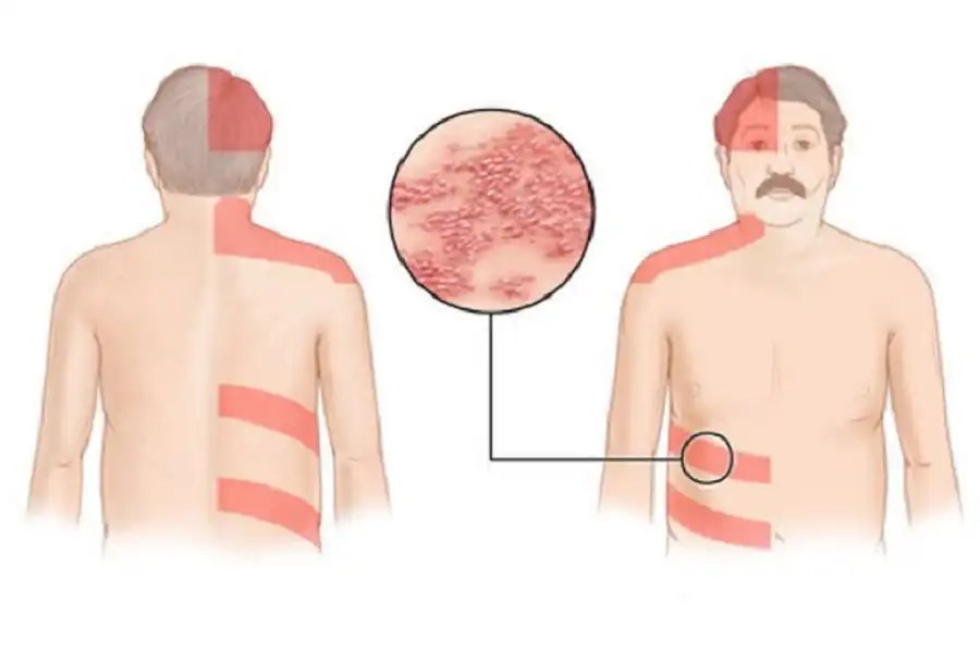 ضایعات پوستی زونا معمولاً دردناک و تاولدار، در یک طرف بدن و اغلب روی تنه ظاهر میشوند.