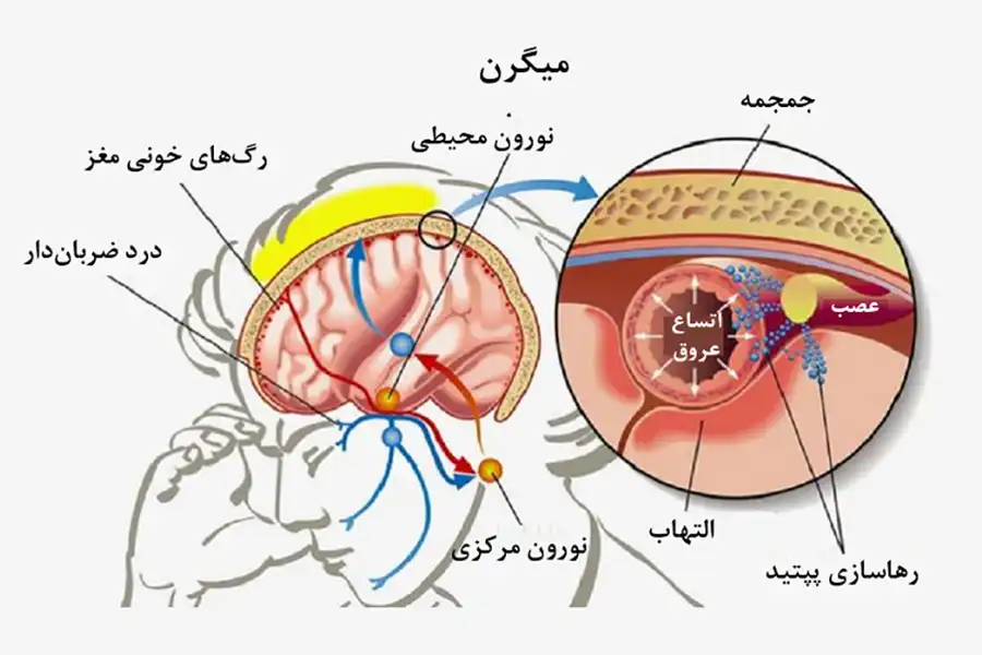 میگرن، یک بیماری عصبی است که دلیل ایجادش، دقیقاً مشخص نیست، اما به تأثیرات ناهنجاریهای ناشی از عوامل ژنتیکی یا محیطی بر سیستم عصبی نسبت داده میشود.
