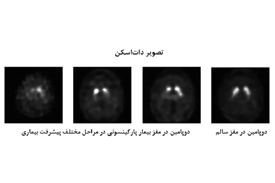 تصویر داتاسکن دوپامین مغز سالم و مغز بیمار پارکینسونی