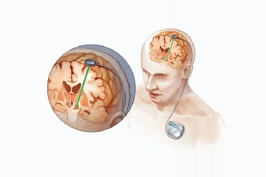جراحی تحریک عمقی مغز، در مراحل پیشرفته بیماری که اثرگذاری داروها کاهش و میزان دیسکنزی و دورههای خاموش افزایش مییابد، انجام میشود.