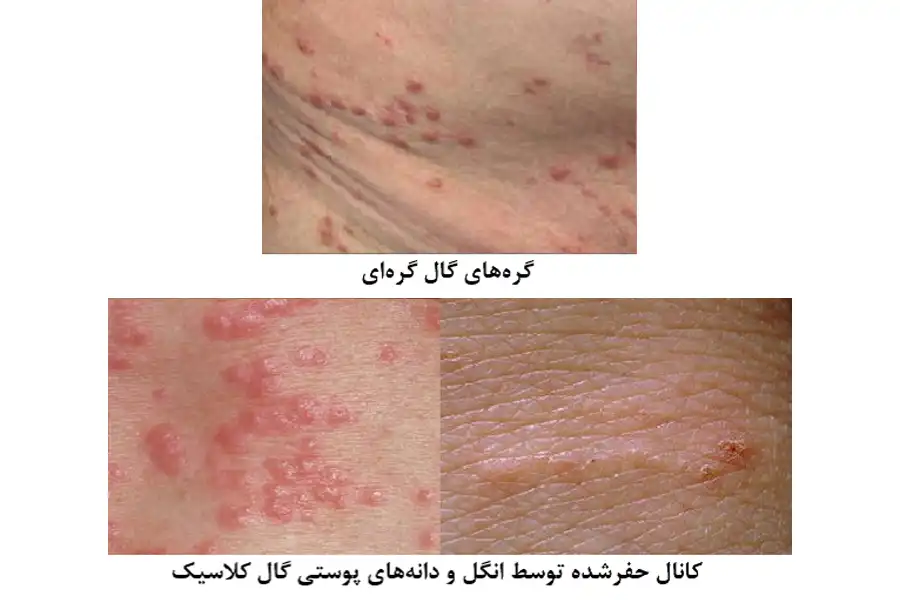 نمایی از گال گرهای و گال کلاسیک
