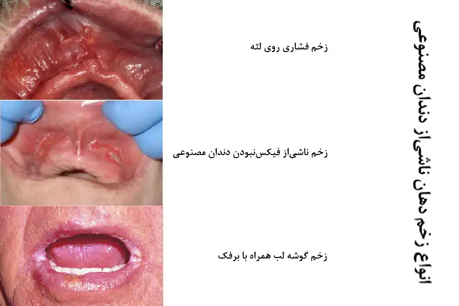 انواع زخم دهان ناشی از دندان مصنوعی