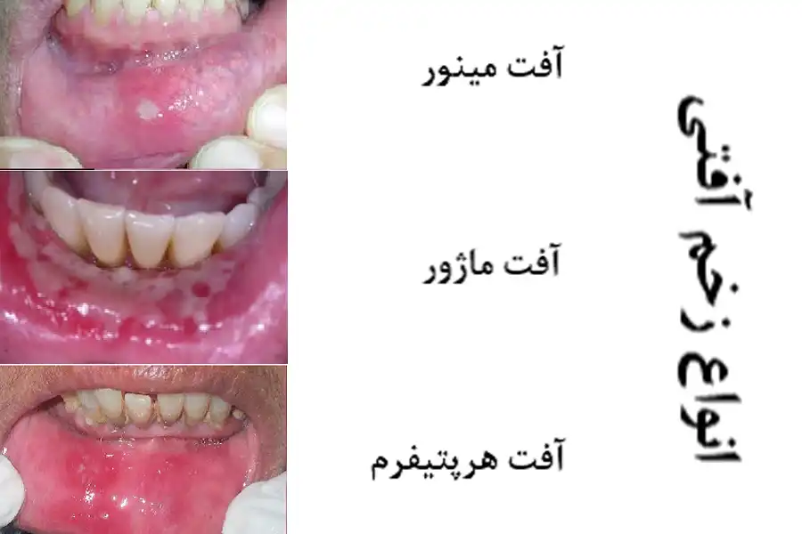 انواع زخم دهان آفتی