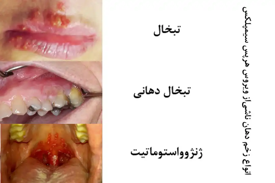 انواع زخم دهان ناشی از ویروس هرپسسیمپلکس