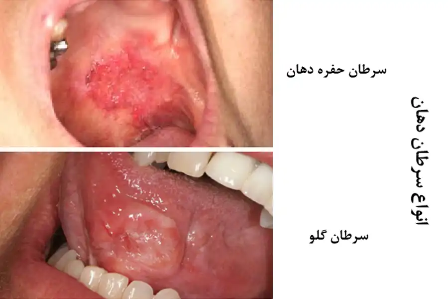 انواع سرطان دهان بر اساس محل ایجاد سرطان